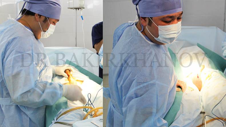 фото: Сарвар Казимович на операции фаллопротезирвоания