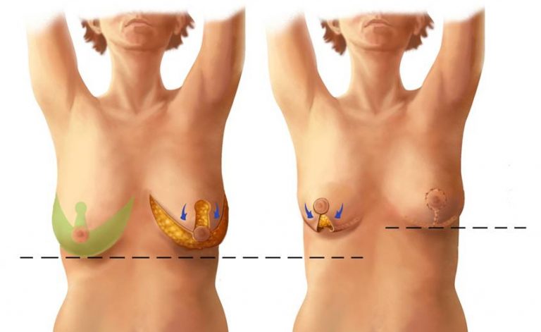 схема: вертикальный способ подтяжки груди