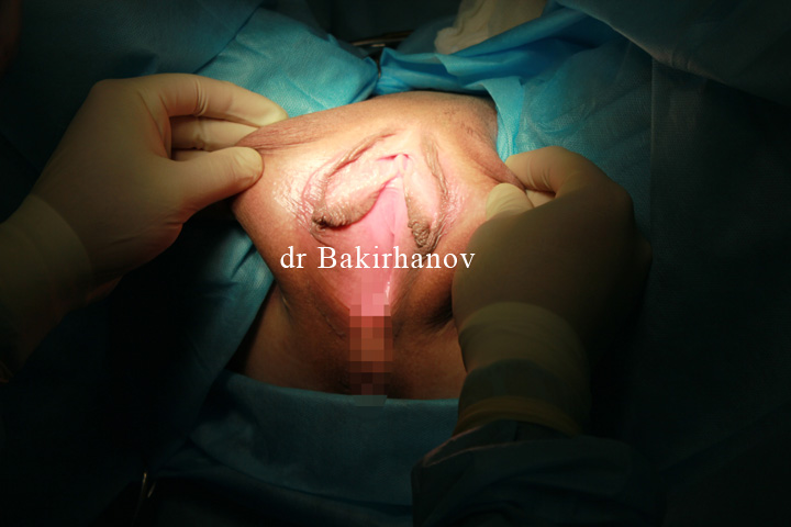 фото: операция пластика больших половых губ