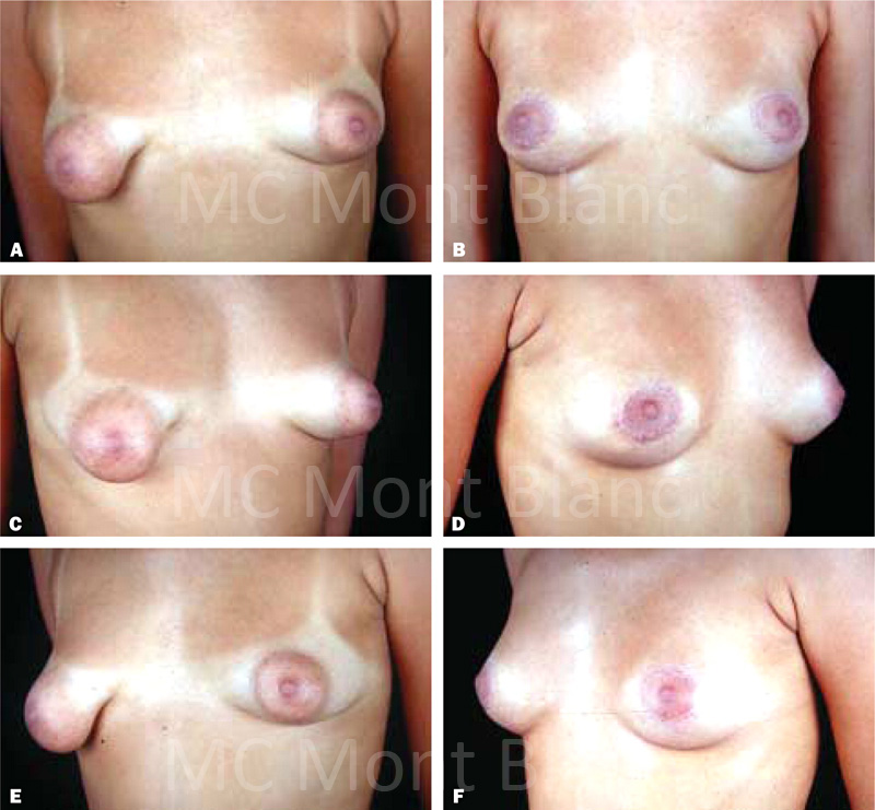 Коррекция тубулярной груди фото до и после
