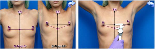 система дооперационного моделирования груди Biodynamic Breast Analysis
