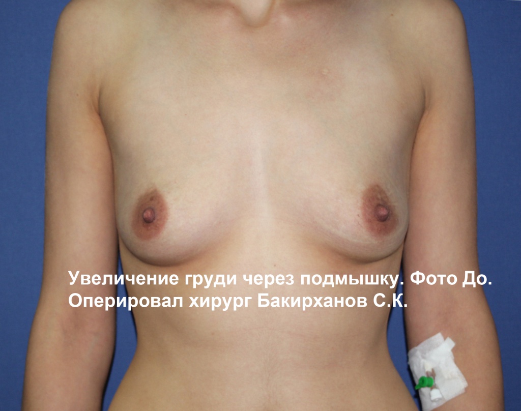 Эндоскопическое увеличение груди (Бакирханов С.К.)