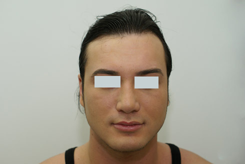 Ринопластика у мужчин фото до и после, хирург Салиджанов АШ 2