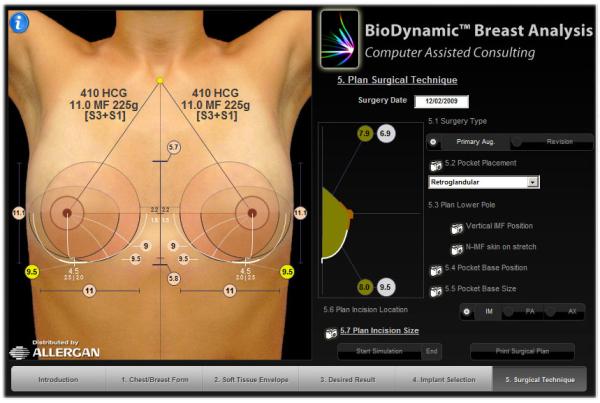 система дооперационного моделирования груди Biodynamic Breast Analysis