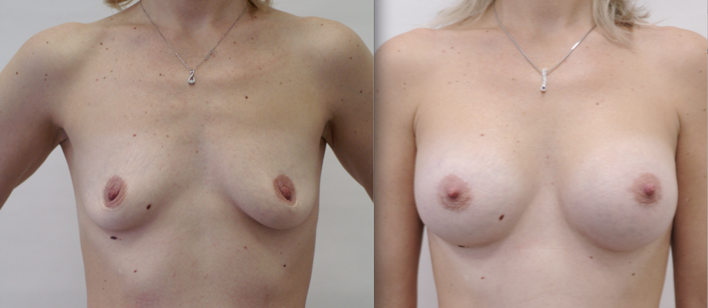 фото до и после операции увеличения груди
