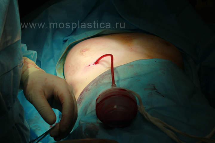 фото операции повторного удаления геля из груди