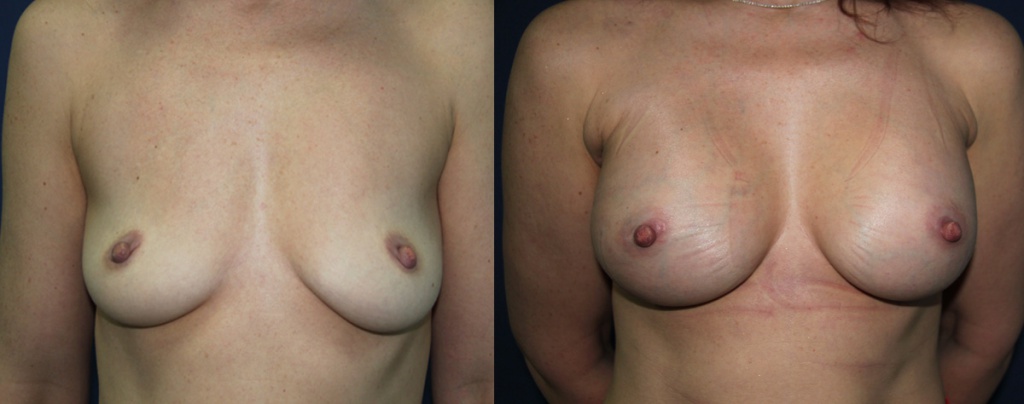 Эндоскопическое увеличение груди (Бакирханов С.К.)