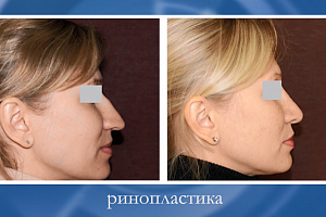 Ринопластика кончика носа и блефаропластика - одновременная операция