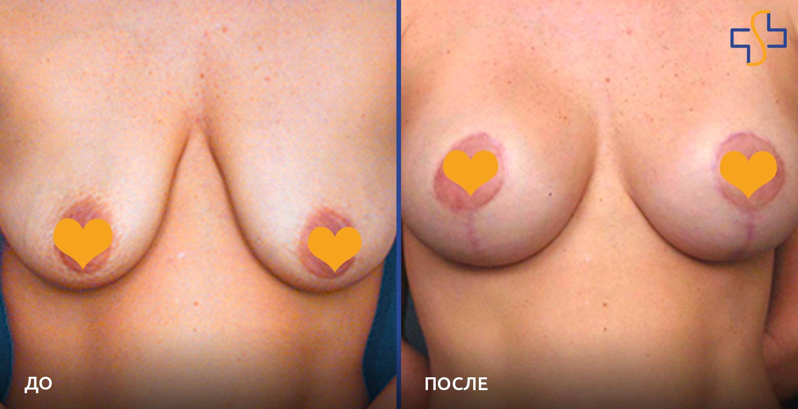 фото груди после операции подтяжки груди