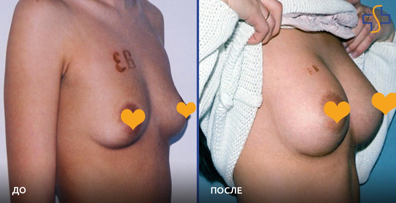 фото до и после операции по увеличению молочных желез