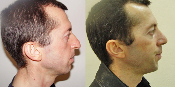 фото: до и посе ринопластики кавказского носа