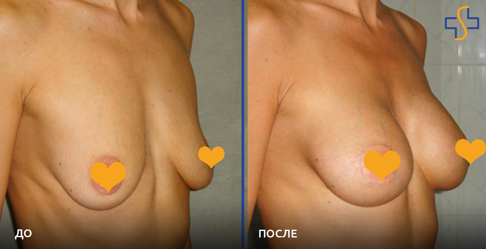 фото до/после проведенной операции по увеличению груди