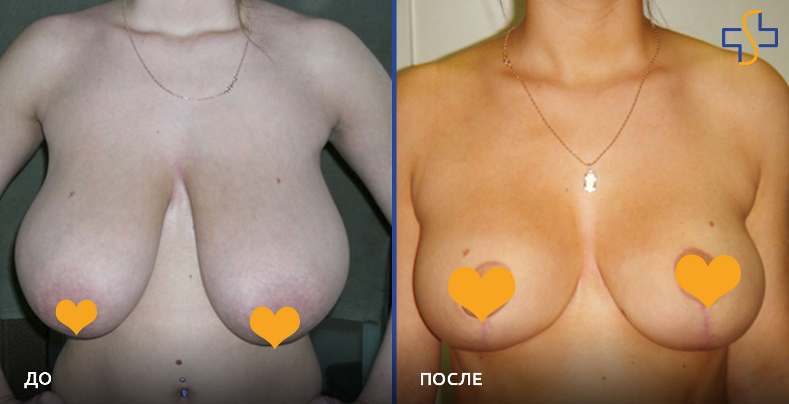 фото до и после проведенной редукционной маммопластики