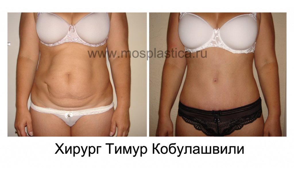 Абдоминопластика фото до и после (хирург - Тимур Кобулашвили)