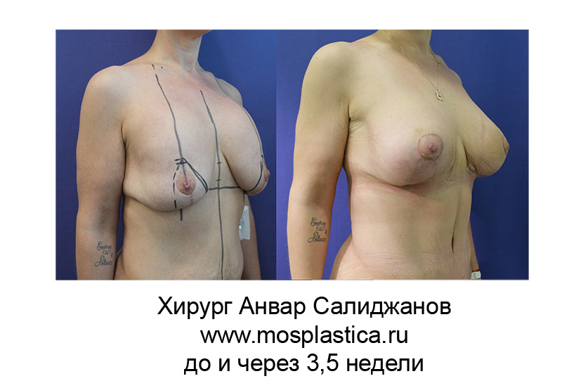 фото до и после подтяжки груди на имплантах 3,5 недели (хирург Салиджанов Анвар)