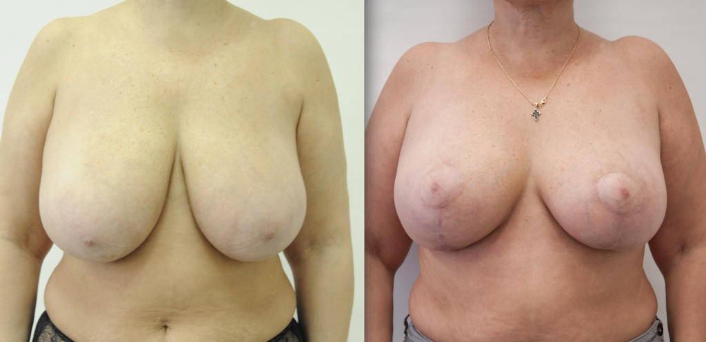 уменьшение груди до и после Салиджанов 1