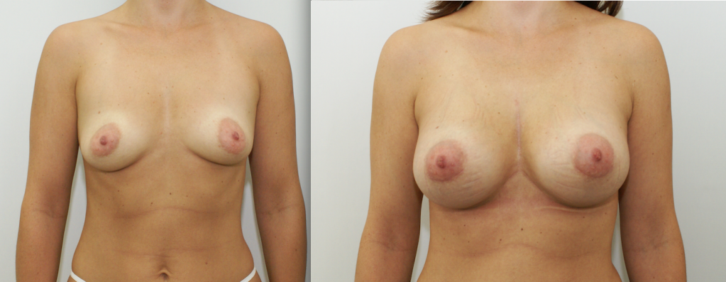 фото: до и после увеличения груди хирургом Салиджановым