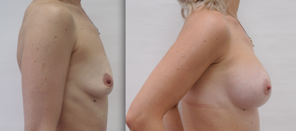 подтяжка груди после родов. грудь после родов. фото до и после, хирург Салиджанов А.Ш. 4