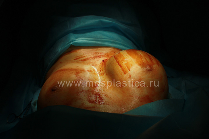 фото операции повторного удаления геля из груди