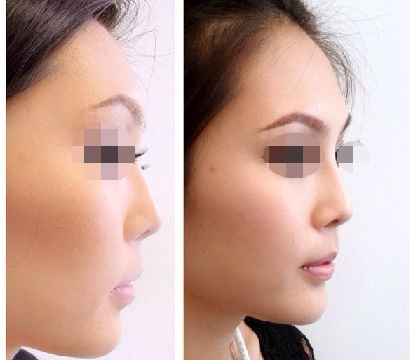 фото до и после: пластика азиатского носа до и после