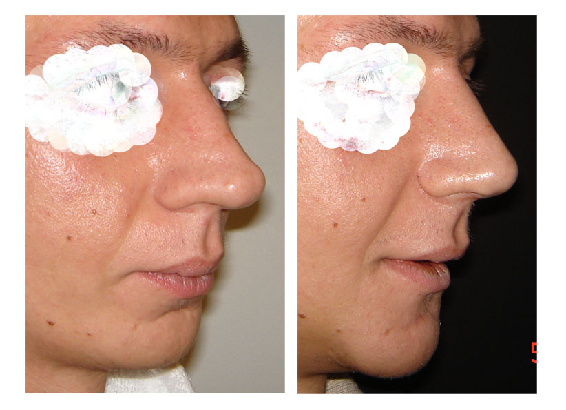 Операция после перелома носа фото до и после. Хирург Тимур Кобулашвили