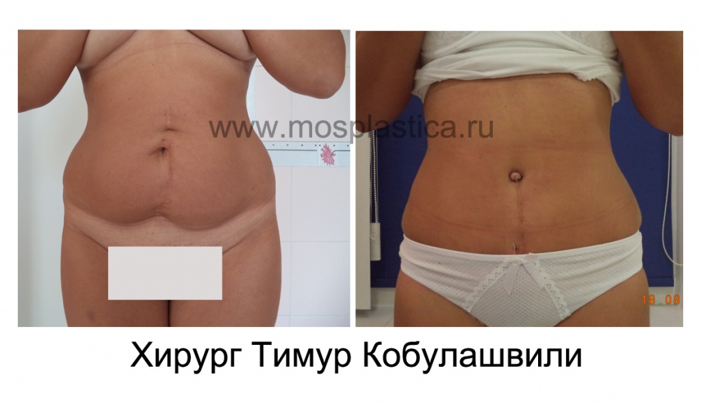 Абдоминопластика фото до и после. Хирург - Тимур Кобулашвили