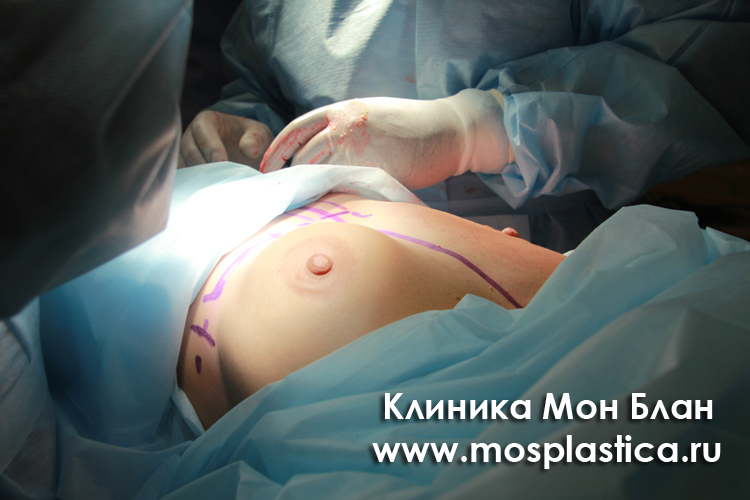 Ткани правой груди "очищены"