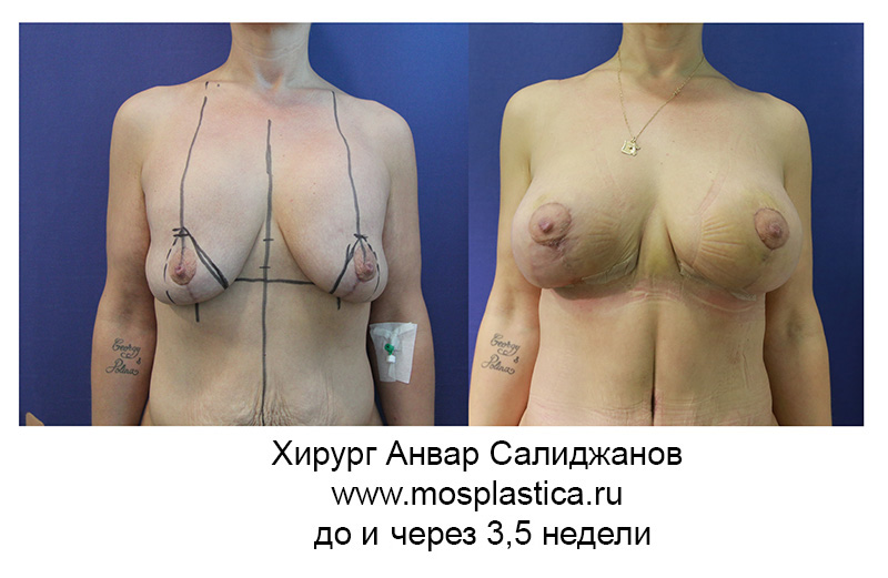 фото до и после подтяжки груди на имплантах - 3,5 недели (хирург Салиджанов Анвар)