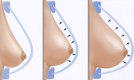 схема проведения коррекции тубулярной груди