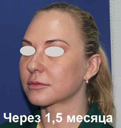 фото после нитевого лифтинга лица, спустя 1,5 месяца