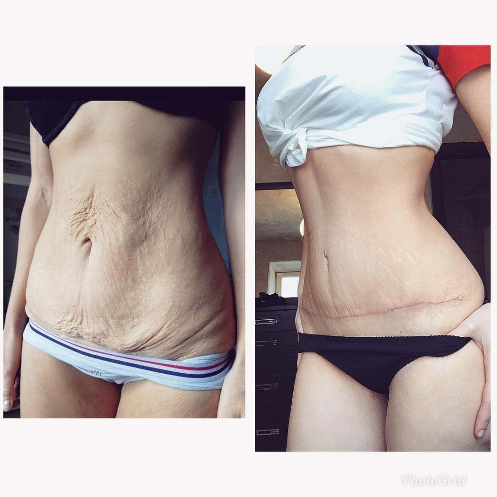 Дарина до и после похудения на 63 кг