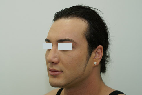 Ринопластика у мужчин фото до и после, хирург Салиджанов АШ 4
