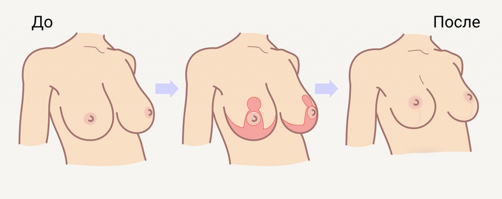 схема проведения операции подтяжки груди после родов