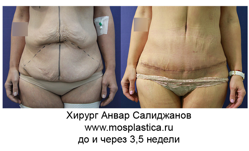пластика живота до и через 3,5 недели (хирург Анвар Салиджанов)