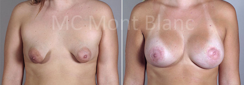пластика тубулярной груди фото до и после