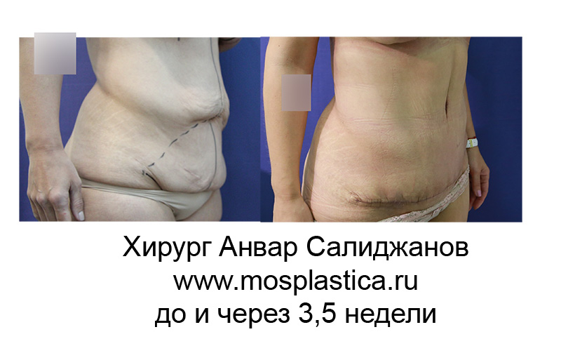 абдоминопластика после похудения - фото до и после (хирург Анвар Салиджанов)