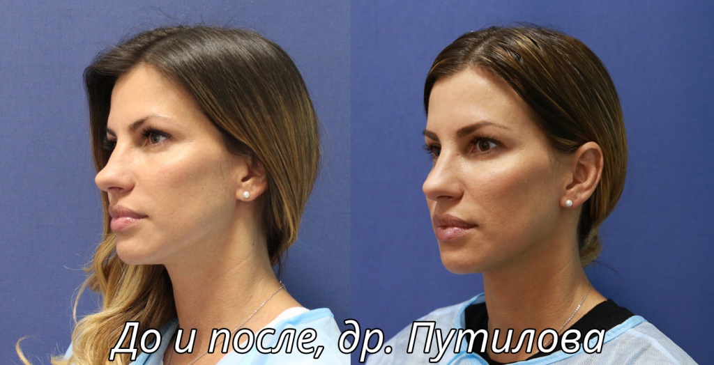 софтлифтинг - фото до и после (пациентка Яна Милимерова)