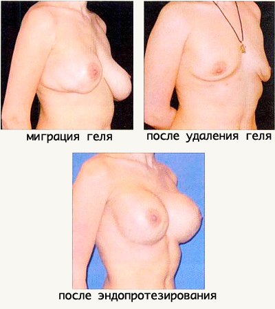 операция: удаление геля из груди