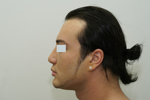 Ринопластика у мужчин фото до и после, хирург Салиджанов АШ 6