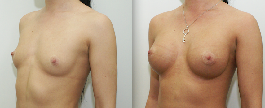 Увеличение груди хирург до и после  Салиджанов Анвар 2