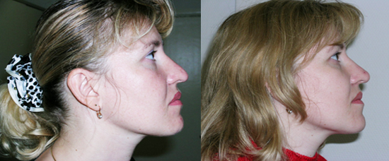 фото до и после: пластика носа без операции. хирург Суламанидзе М.А.
