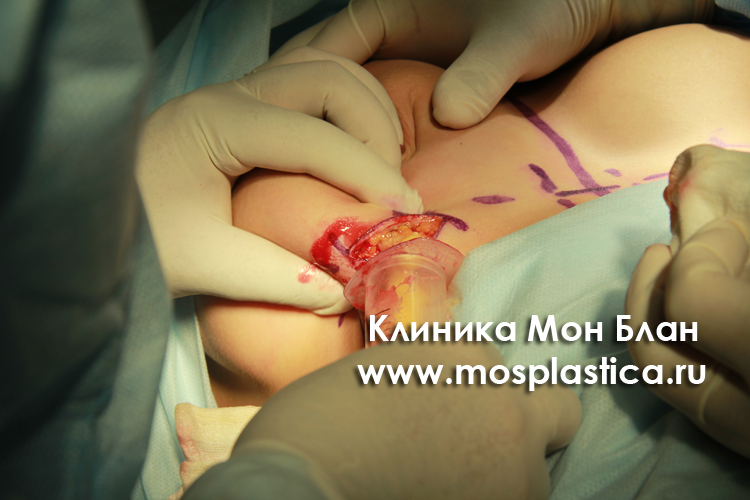 Полиакриамидный гель в груди