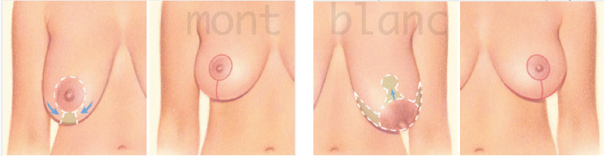 схема: варианты разрезов при уменьшении груди