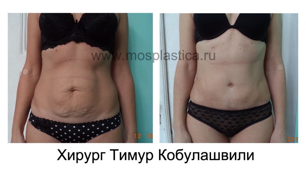 Пластика живота, фото до и после. Хирург - Тимур Кобулашвили