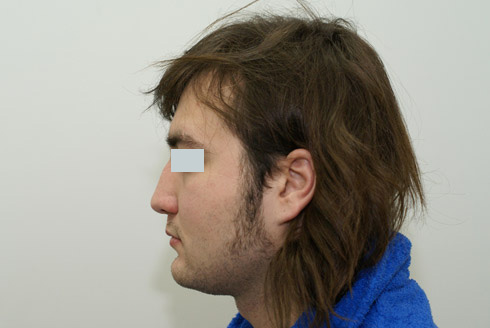 Ринопластика у мужчин фото до и после, хирург Салиджанов АШ 5