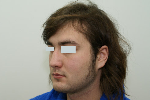 Ринопластика у мужчин фото до и после, хирург Салиджанов АШ 3