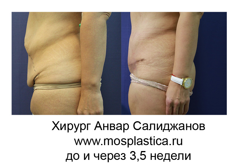 абдоминопластика после похудения фото до и после - фото до и после (хирург Анвар Салиджанов)