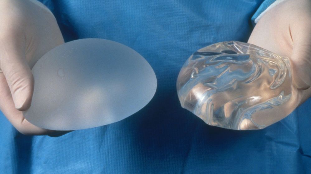фото замены грудных имплантов