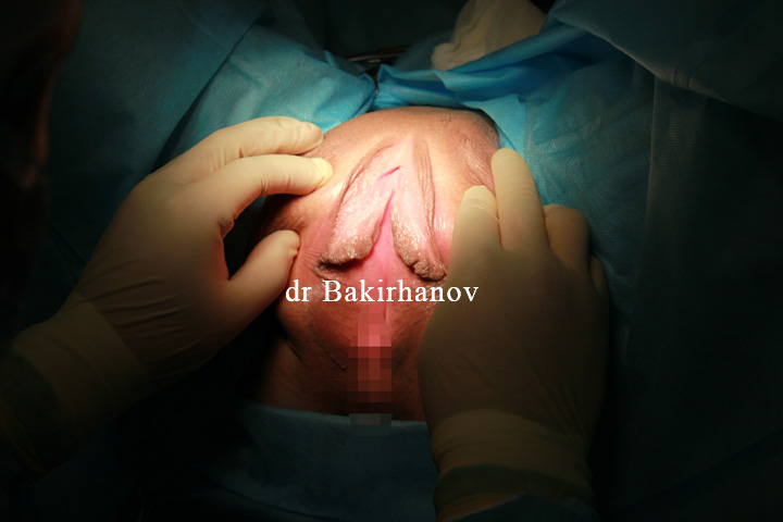 Пластика больших половых губ. др. Бакирханов