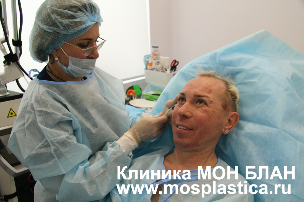 Установка рассасывающихся нитей Александру Пескову. Косметолог Наталья Путилова Установка рассасывающихся нитей Александру Пескову. Косметолог Наталья Путилова